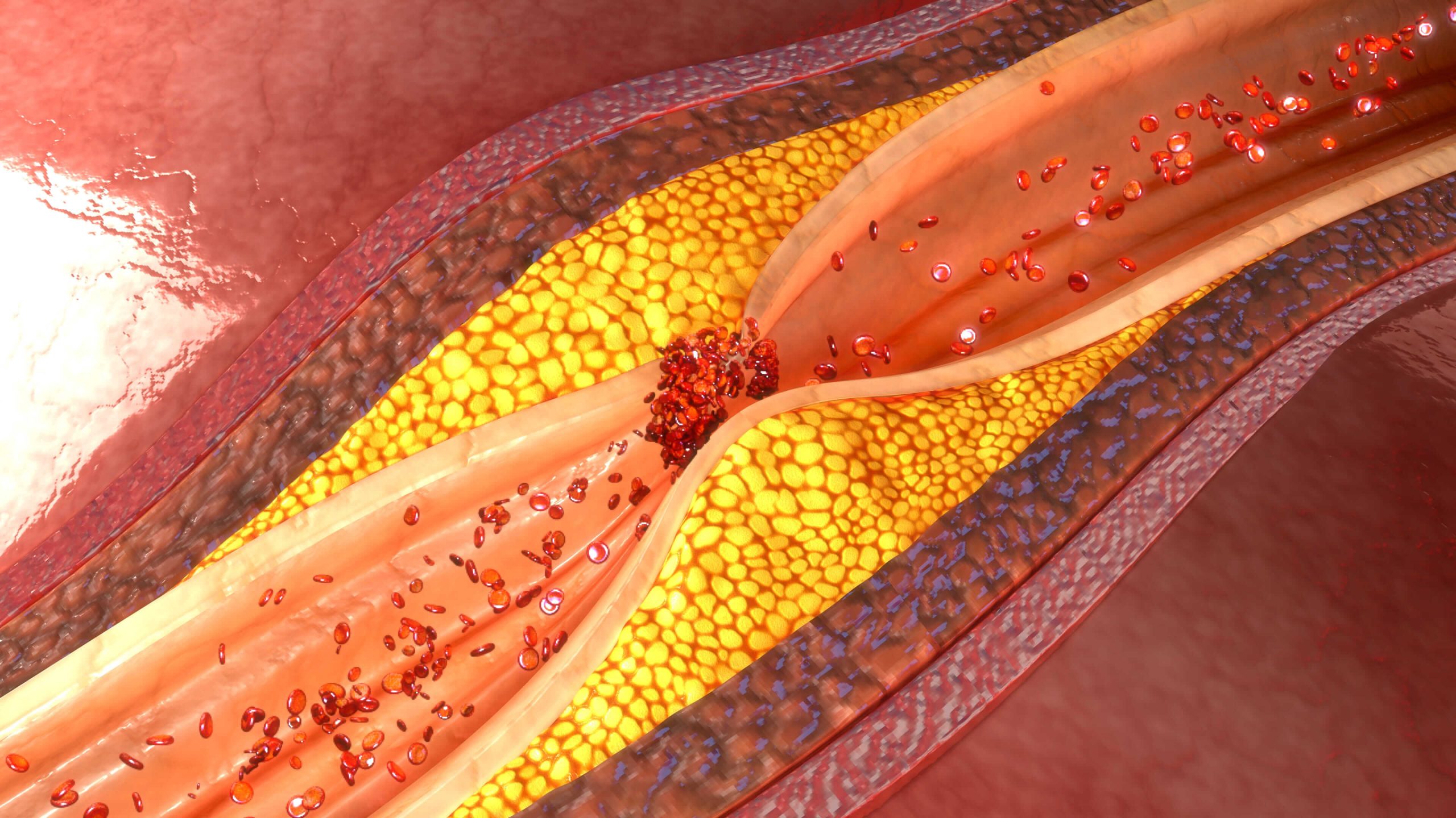 Unlock the Secrets to Dissolve Arterial Plaque Naturally