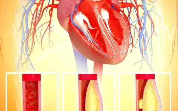 How To Reduce Plaque In Arteries