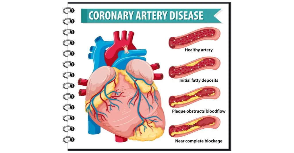 how to dissolve arterial plaque