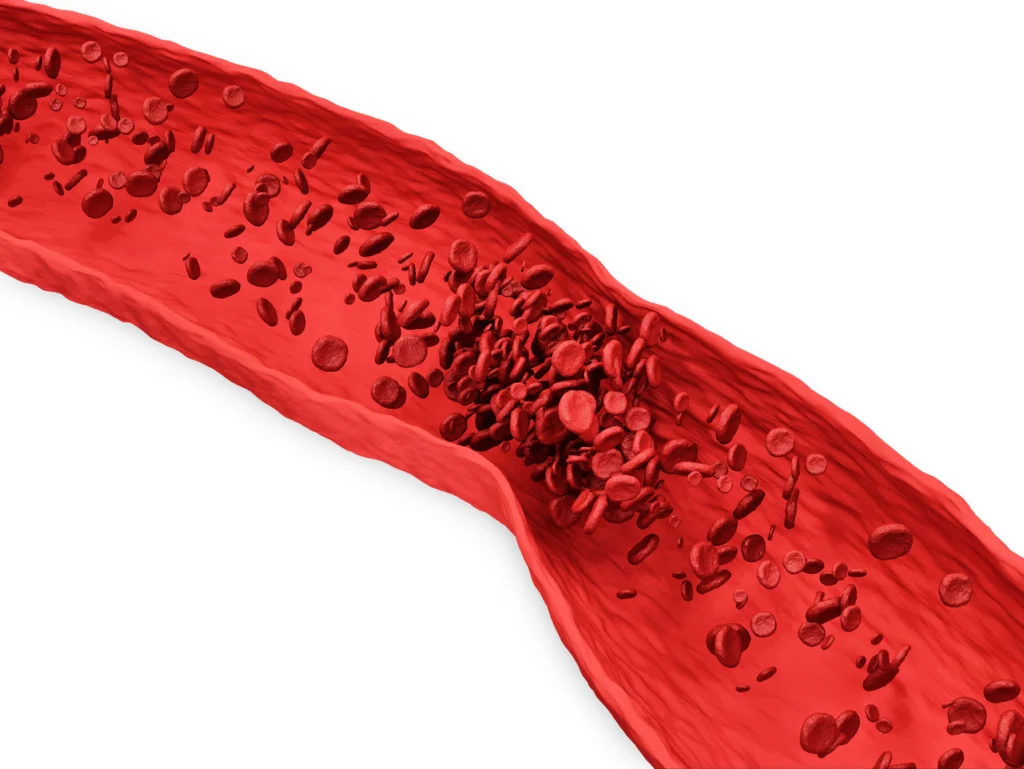 Natural ways to remove blood clots — what science supports​ Vasculex