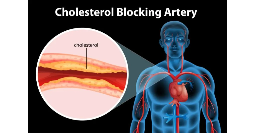 what dissolves arterial plaque